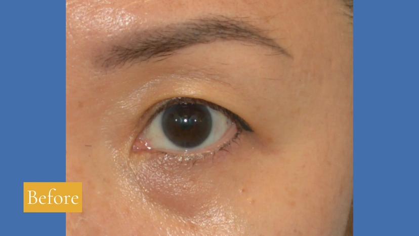 Asian eyelid surgery patient 52 result photo