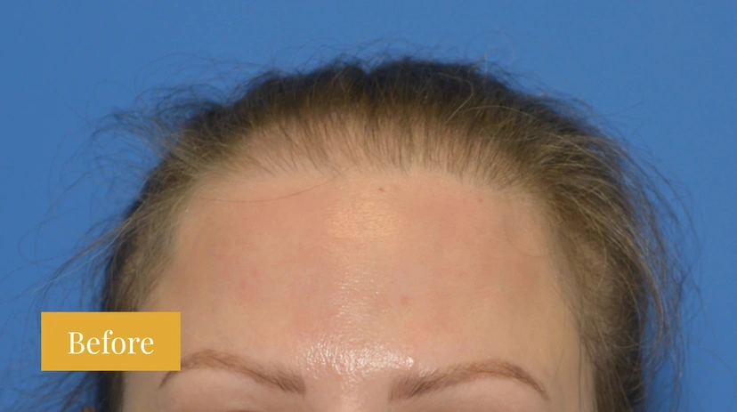 Hair Restoration - Patient 3 (before)