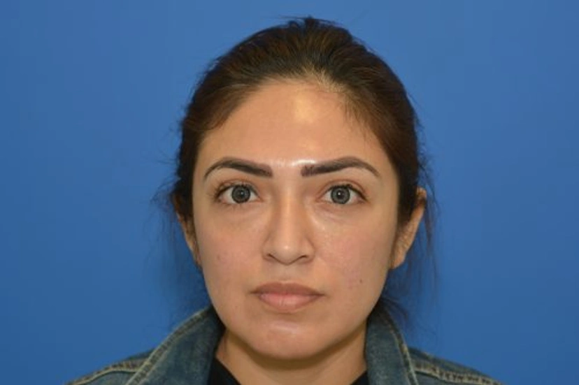 Dermal Fillers - Patient 1 (after)