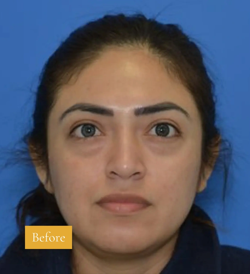Dermal Fillers - Patient 1 (after)