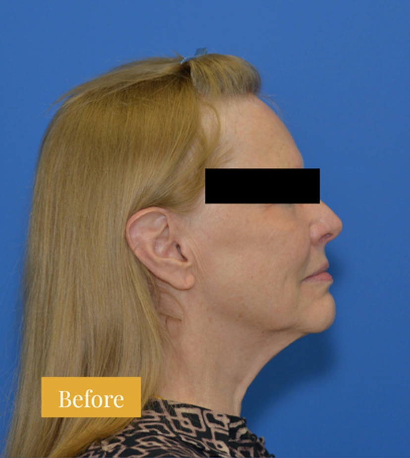 Neck Lift - Patient 1 - Set 1 - Before