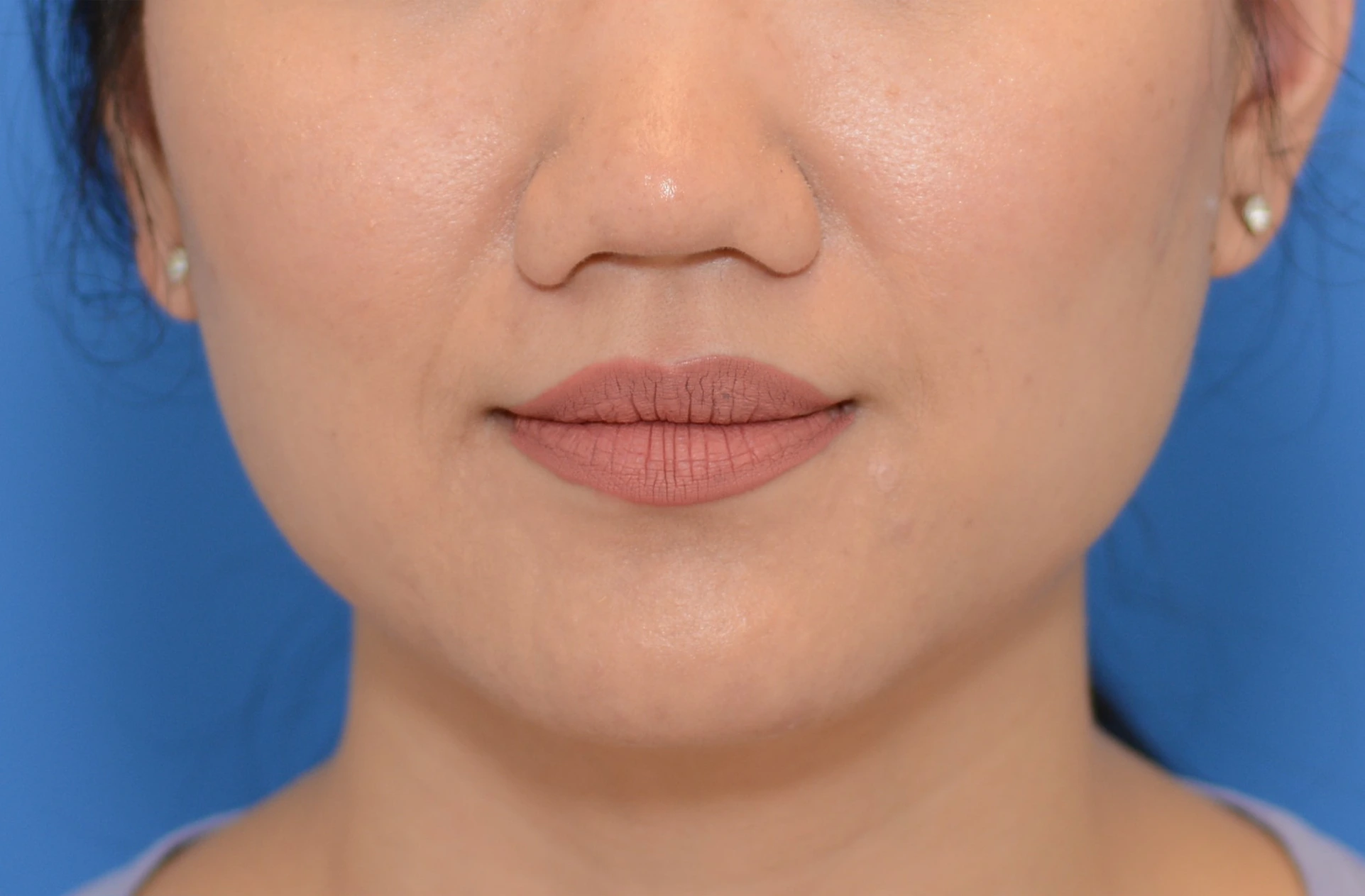Before BOTOX before and after