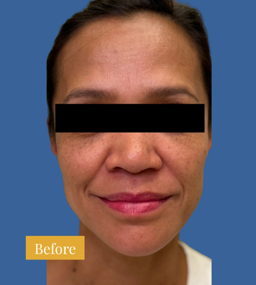 Sculptra - Patient 3 - Set 1 - Before