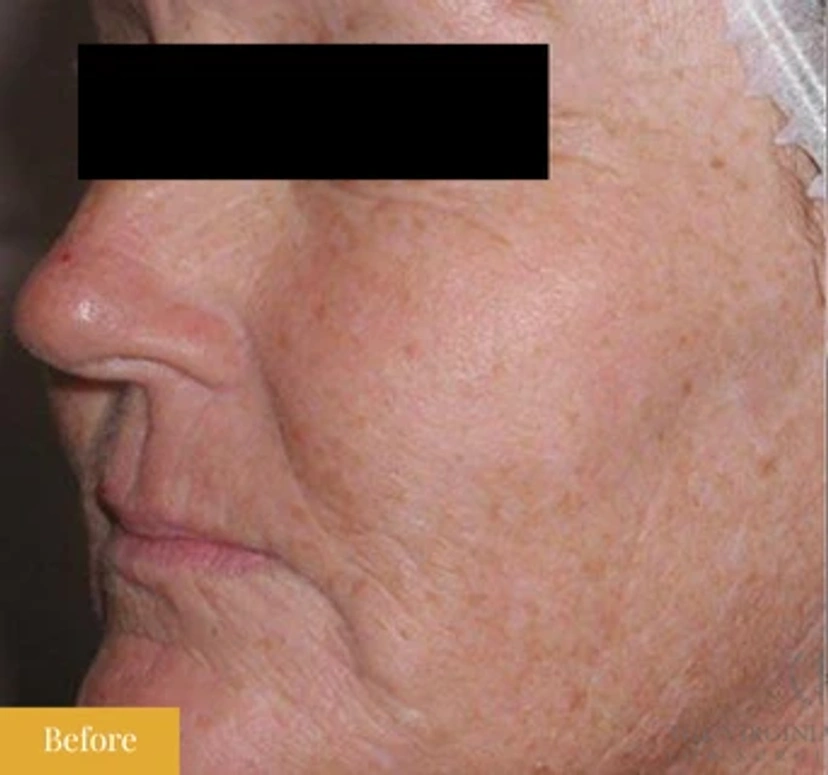 Fraxel - Patient 1 (before)