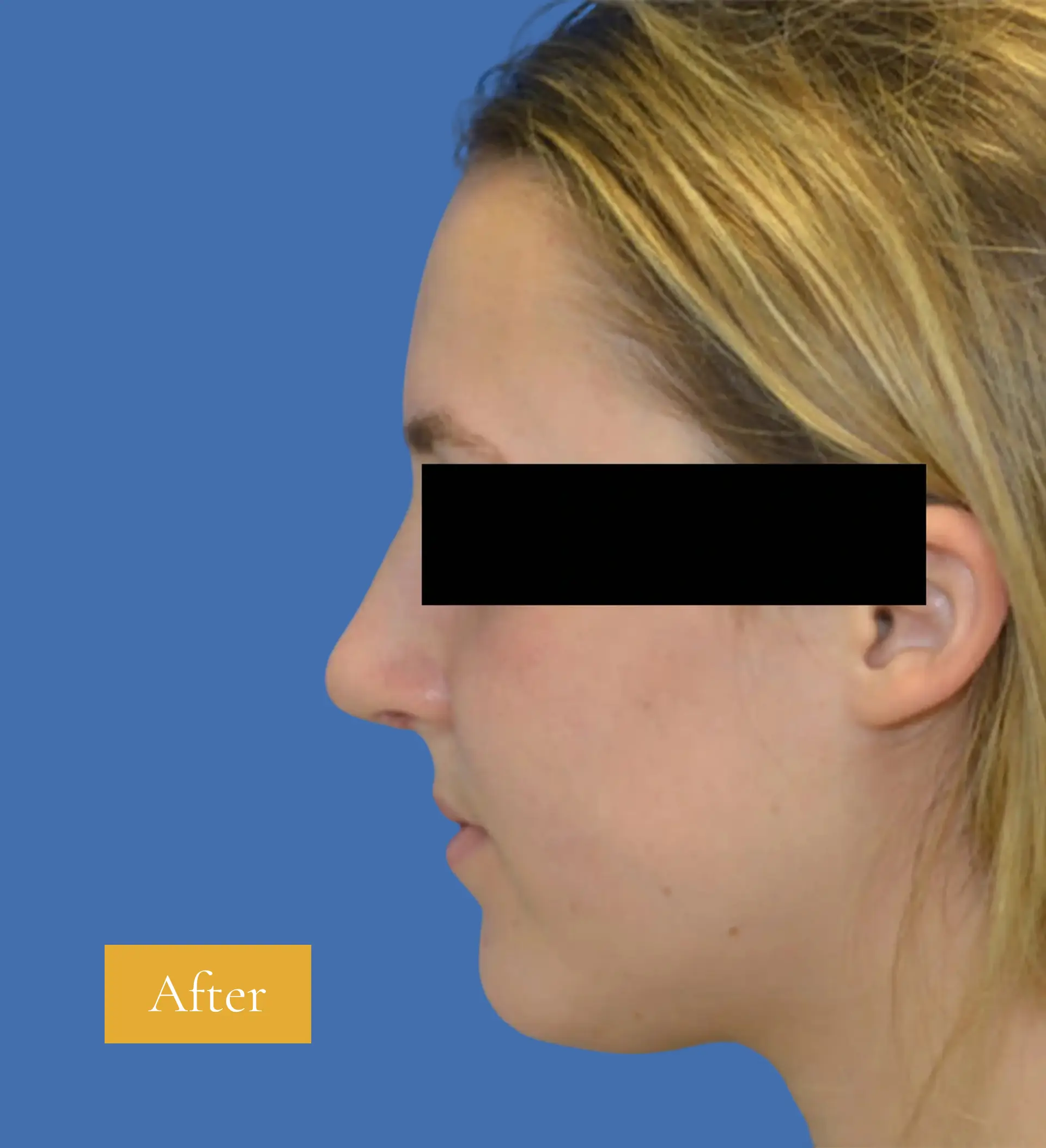 After Neck lift before and after