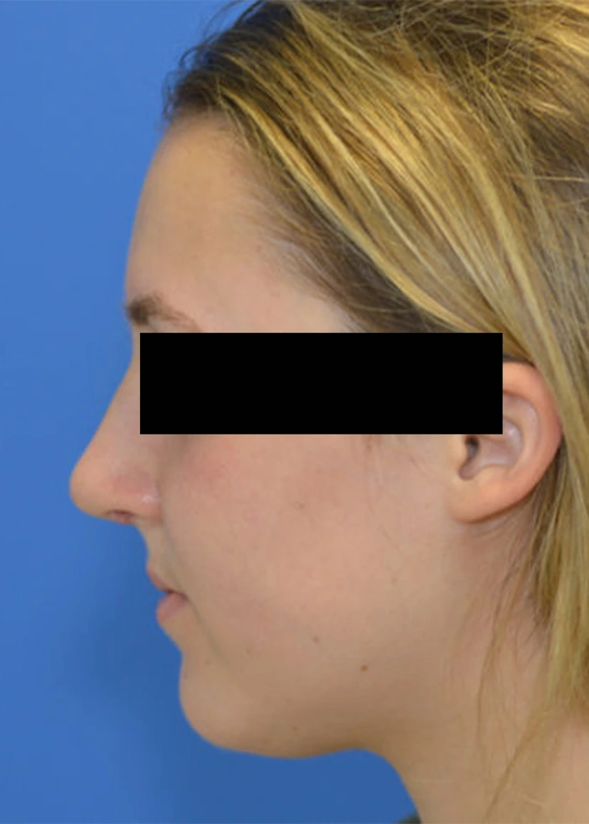 Rhinoplasty - Patient 5 (after)