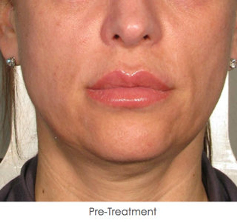 Ultherapy patient 4 result photo