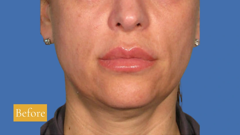 Ultherapy patient 4 result photo