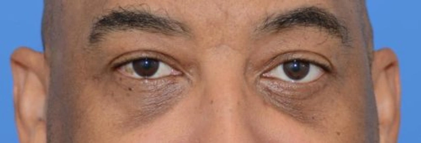Lower Eyelid Surgery - Patient 1 (front view after)