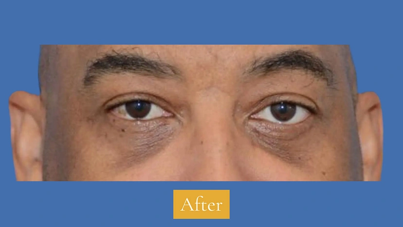 Lower Eyelid Surgery - Patient 1 (front view after)