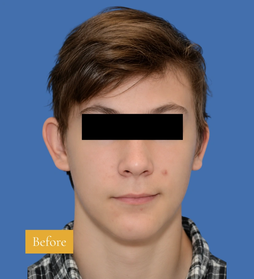 Otoplasty Ear Surgery - Patient 1 (before)