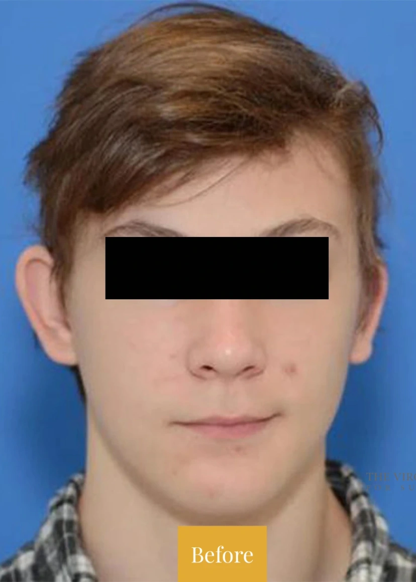 Otoplasty Ear Surgery - Patient 1 (before)