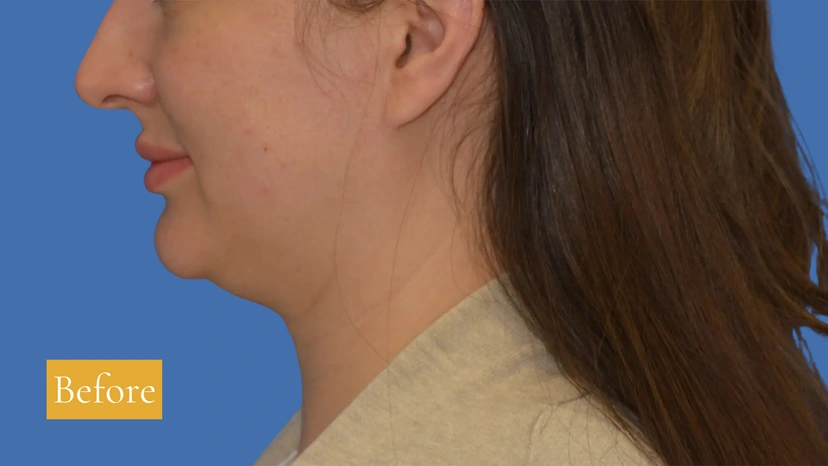 Chin Liposuction - Patient 1 (before)