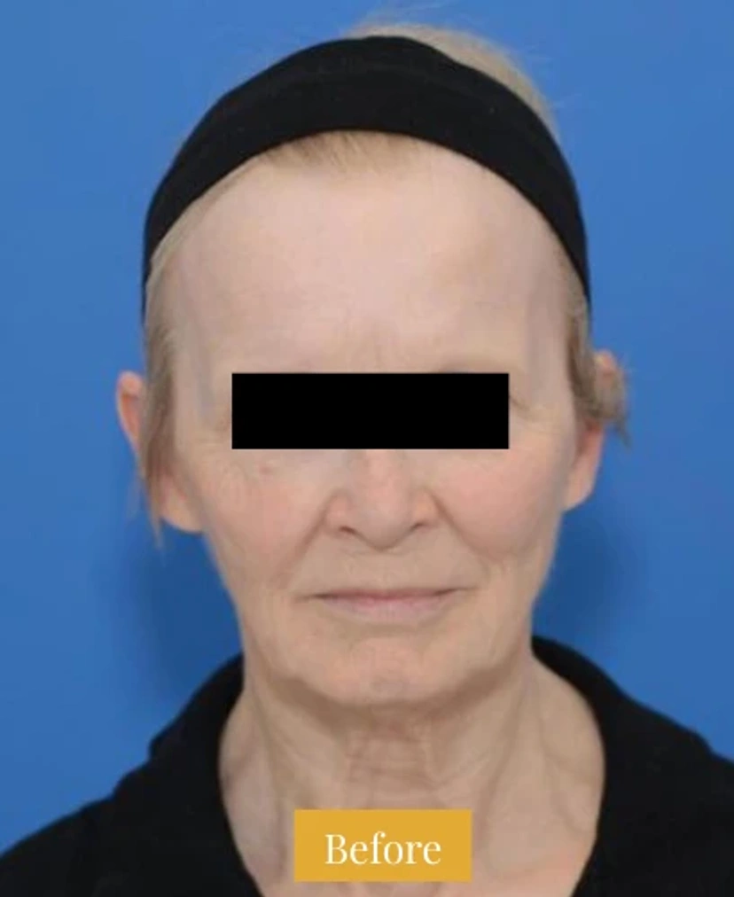 Mini Facelift/Short Scar - Patient 4 (front view before)