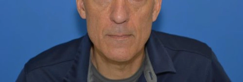 Lower Eyelid Surgery - Patient 3 (after)