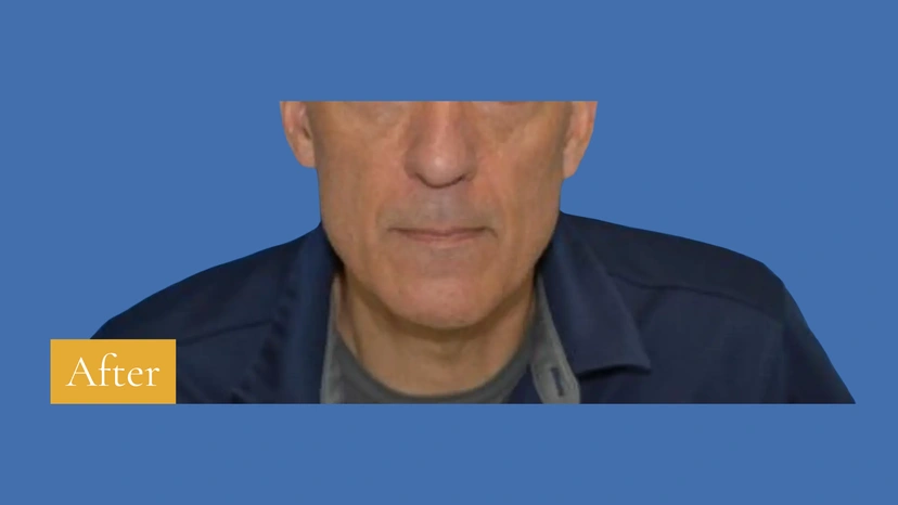 Lower Eyelid Surgery - Patient 3 (after)