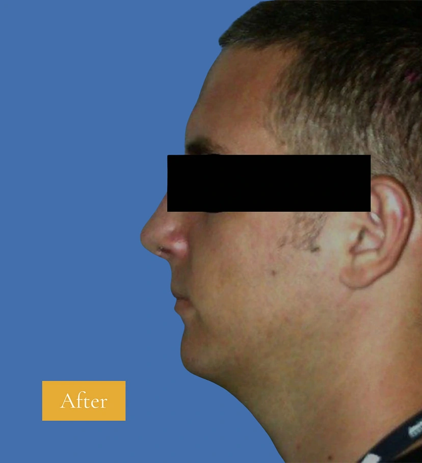 Rhinoplasty - Patient 2 (after)