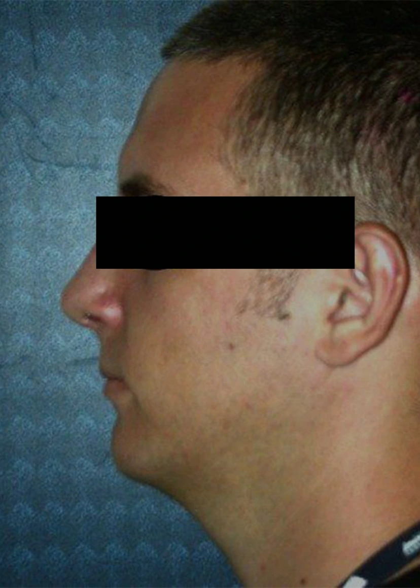 Rhinoplasty - Patient 2 (after)