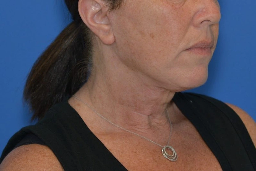 Mini Facelift/Short Scar - Patient 8 (after)