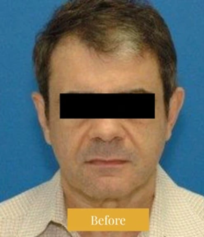 Mini Facelift/Short Scar - Patient 1 (before)