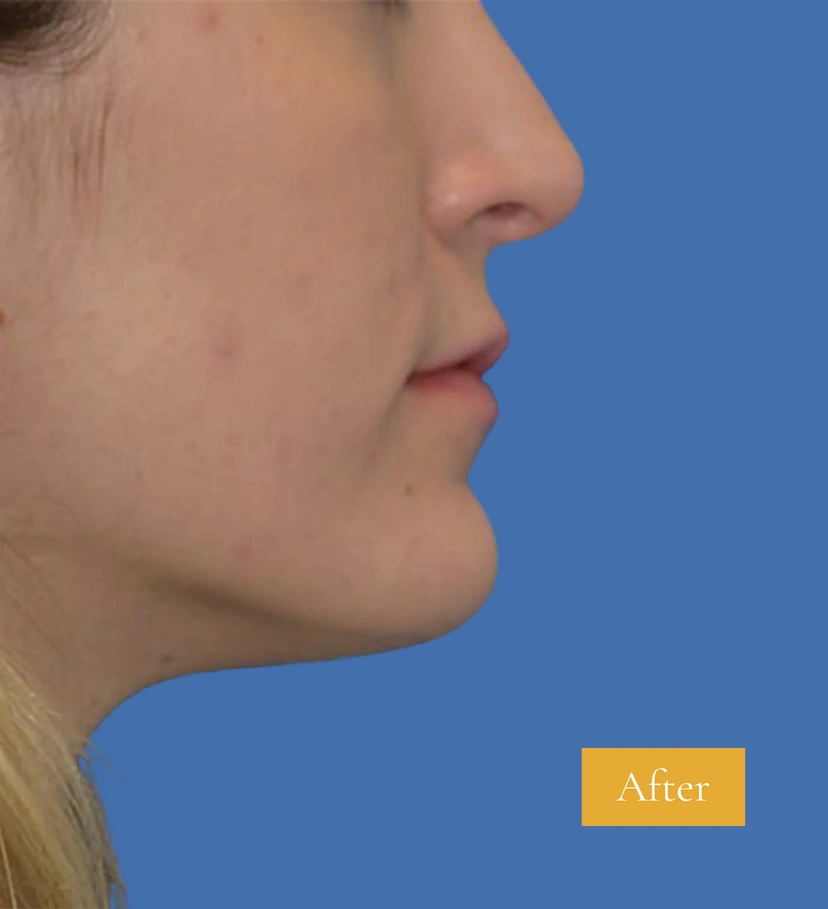 Rhinoplasty - Patient 8 (after)