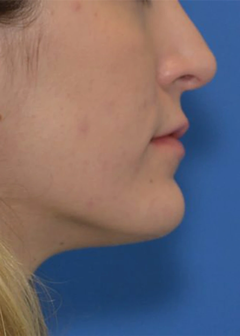 Rhinoplasty - Patient 8 (after)