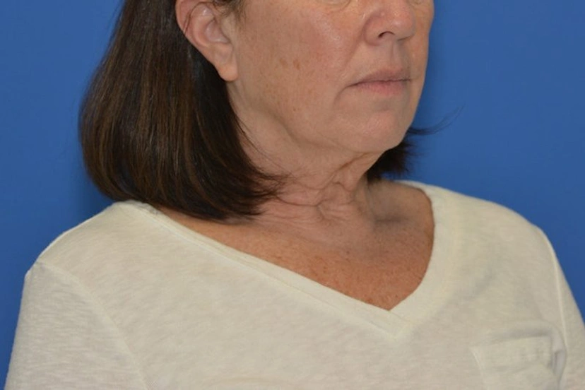 Mini Facelift/Short Scar - Patient 8 (before)