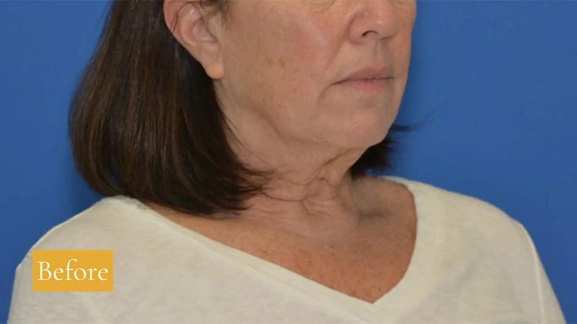 Mini Facelift/Short Scar - Patient 8 (before)
