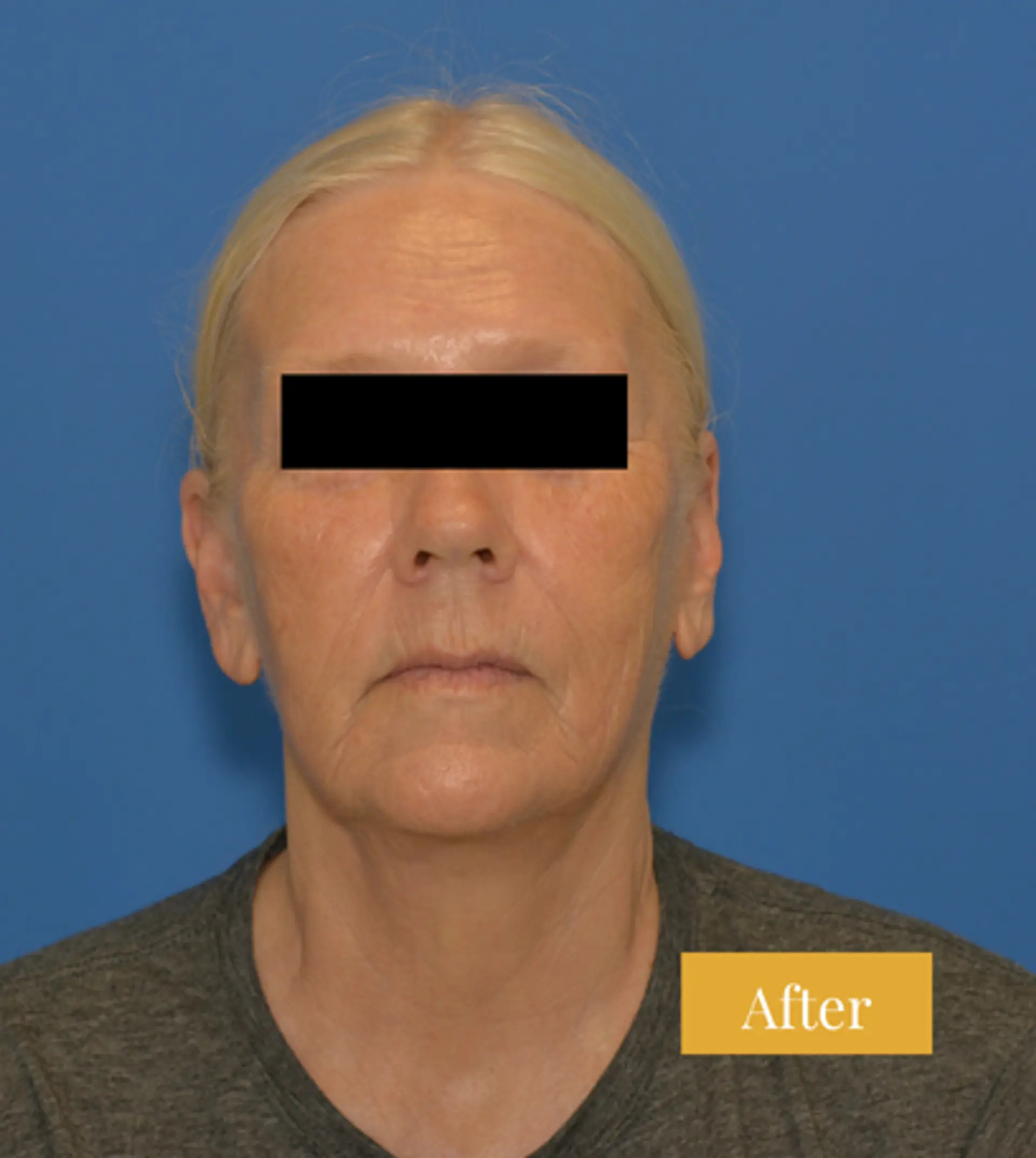 After Facelift before and after