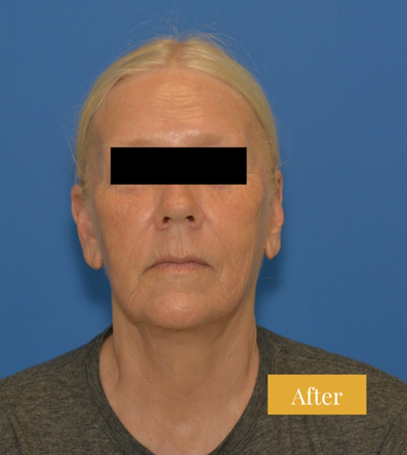 Facelift - Patient 12 - Set 1 - After