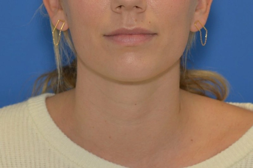 Morpheus8 RF Microneedling - Patient 6 (after)