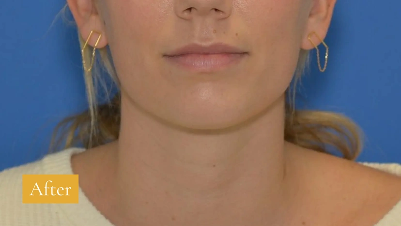 Morpheus8 RF Microneedling - Patient 6 (after)
