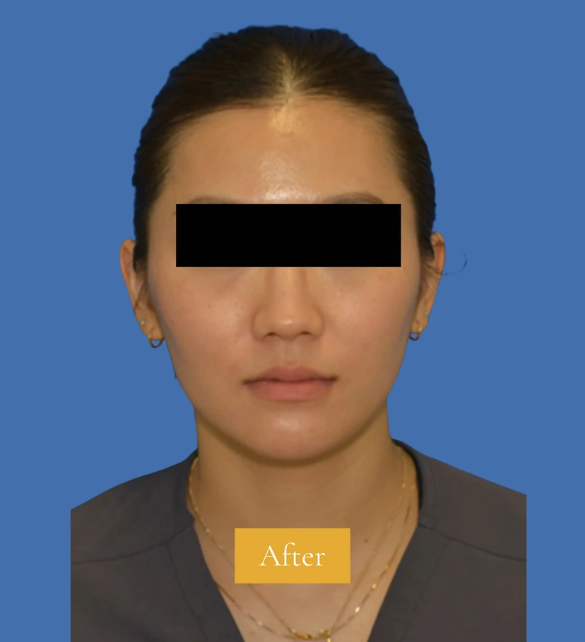 Botox - Patient 4 (front view after)
