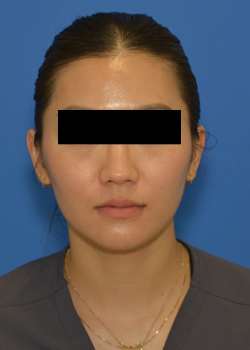 Botox - Patient 4 (front view after)