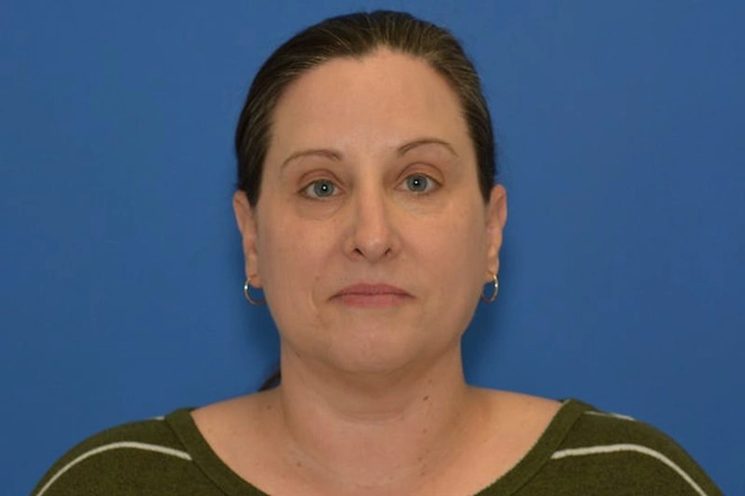 Morpheus8 RF Microneedling - Patient 9 (after)