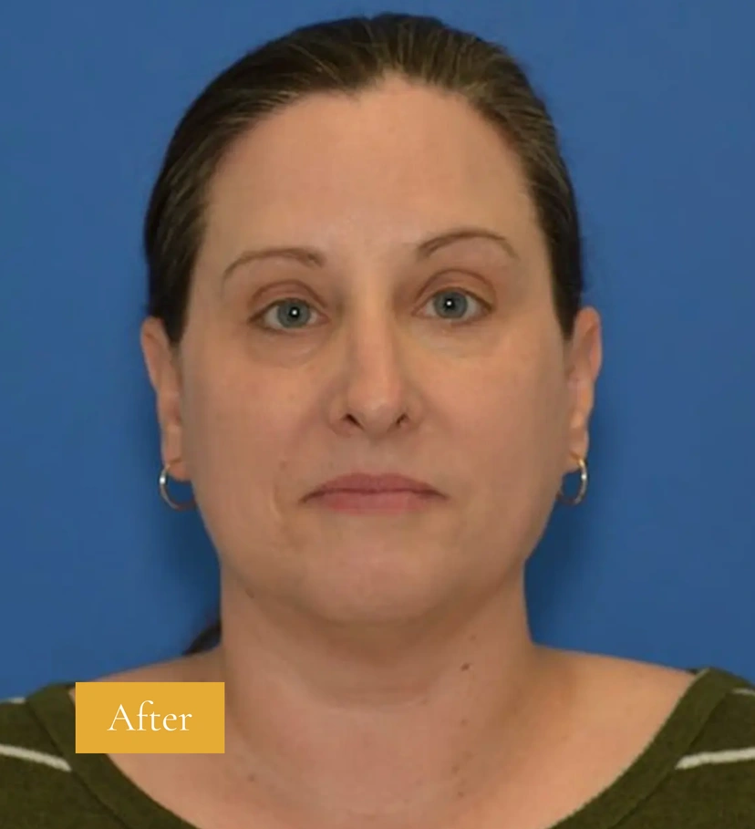 Morpheus8 RF Microneedling - Patient 9 (after)