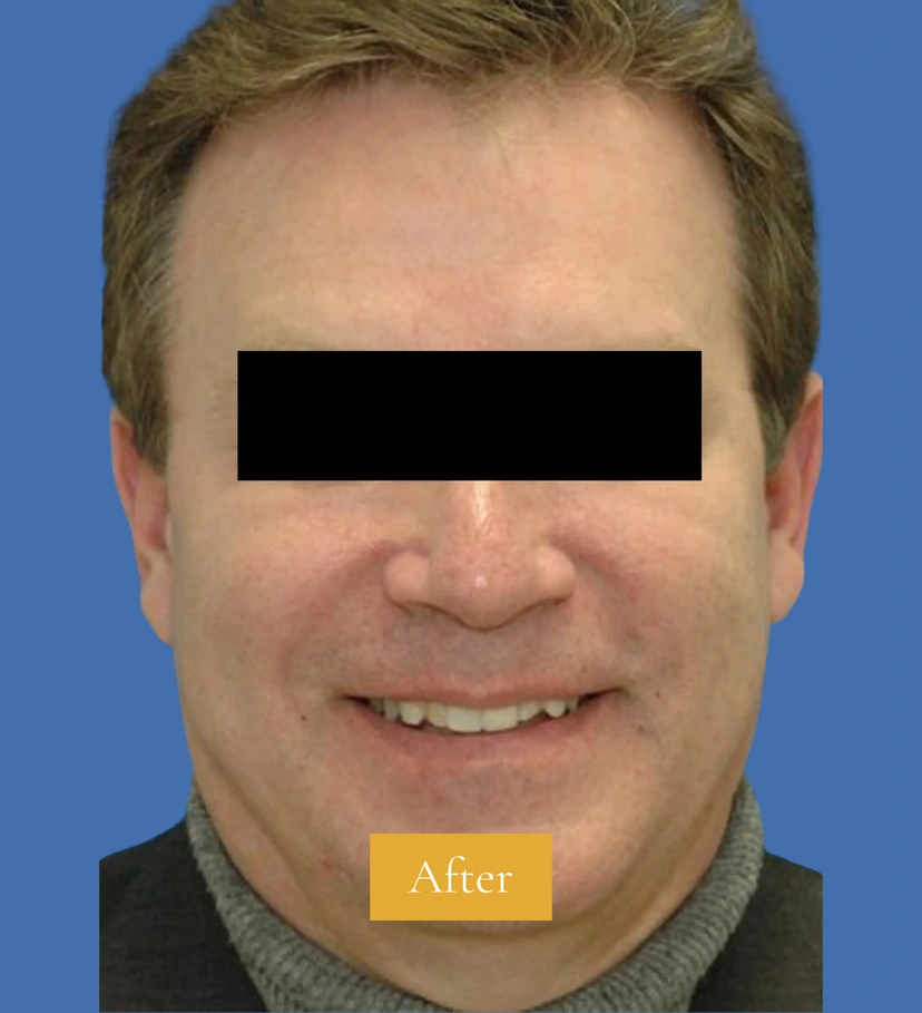 Botox - Patient 1 (front view after)