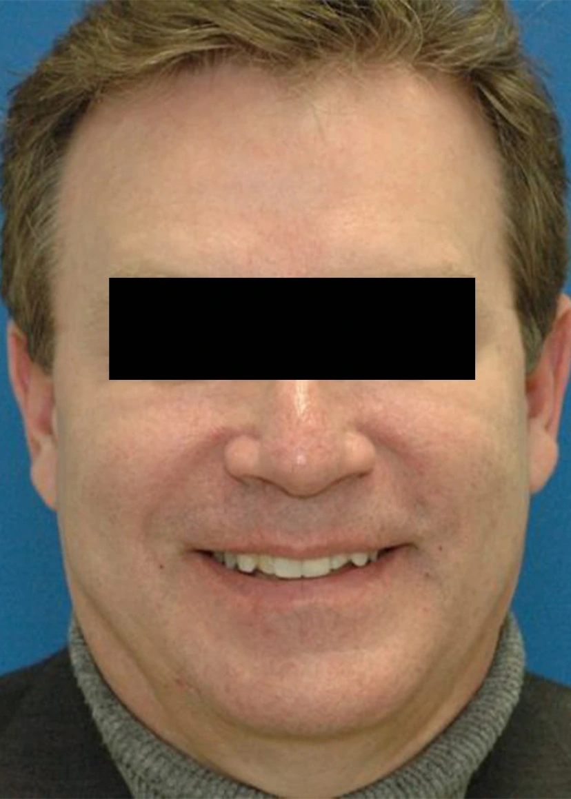 Botox - Patient 1 (front view after)