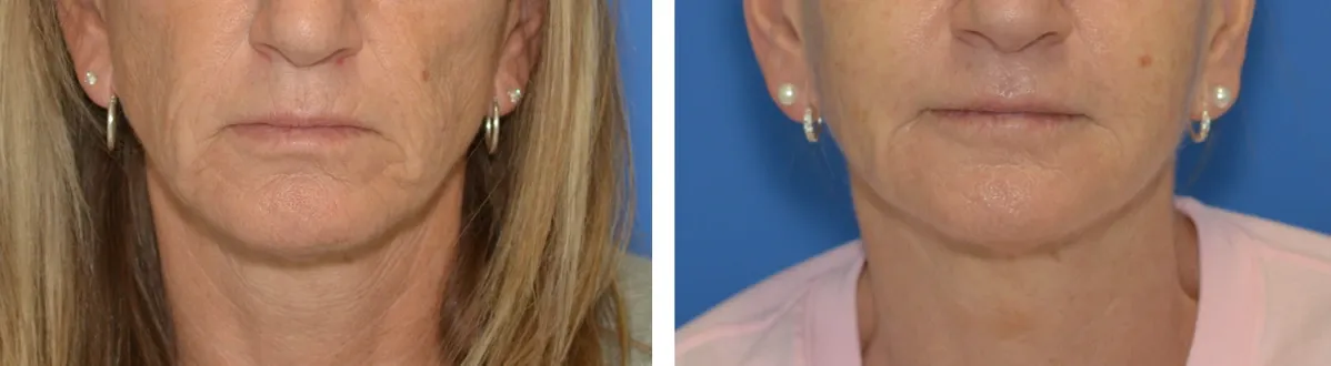 Blog How Treat Skin Crepiness Img2