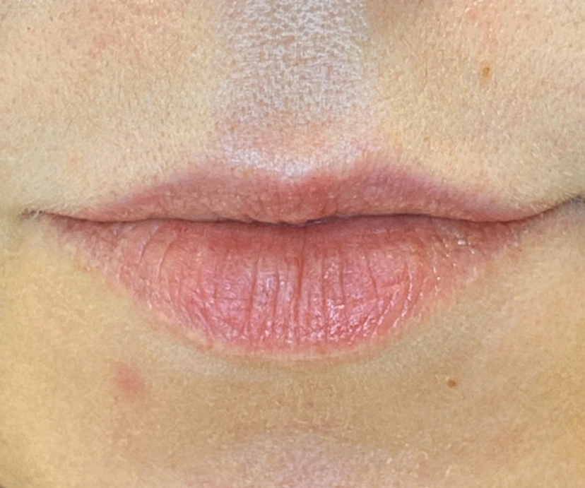 Dermal Fillers - Patient 3 (before)
