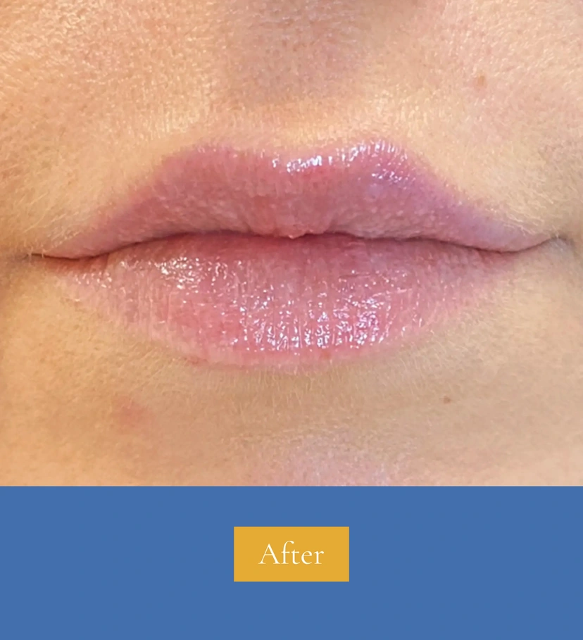 Dermal Fillers - Patient 3 (before)
