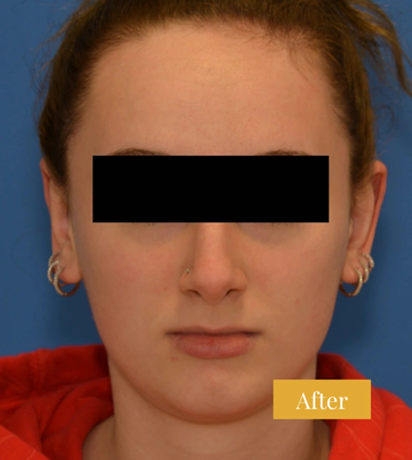 Otoplasty Ear Surgery - Patient 3 - Set 1 - After