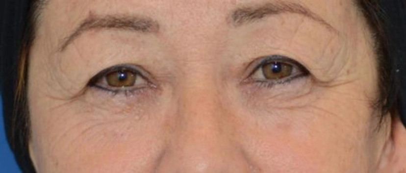 Upper Eyelid Surgery - Patient 3 (front view before)