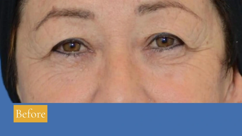 Upper Eyelid Surgery - Patient 3 (front view before)