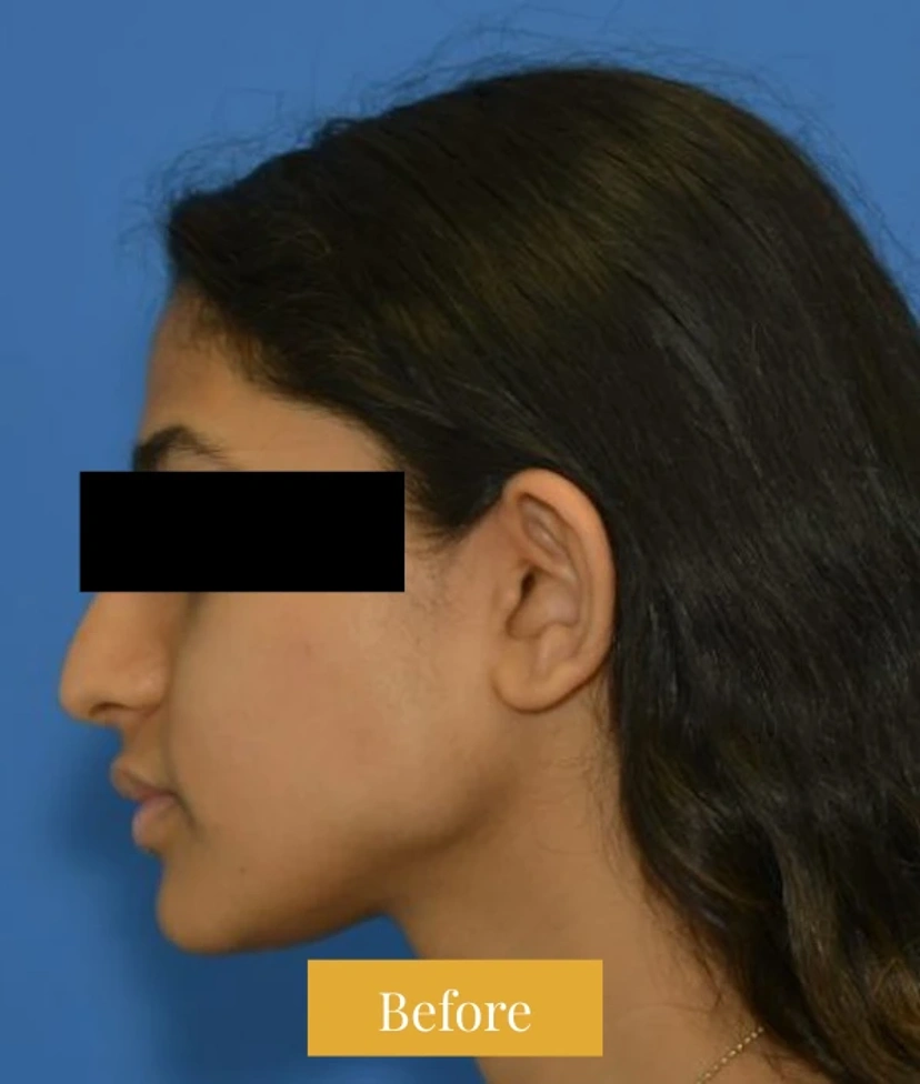 Rhinoplasty - Patient 6 (side view left before)