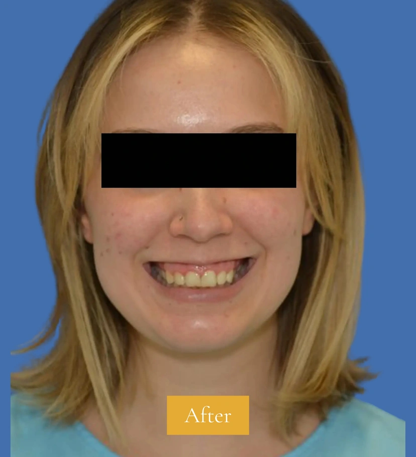 Botox - Patient 2 (front view after)