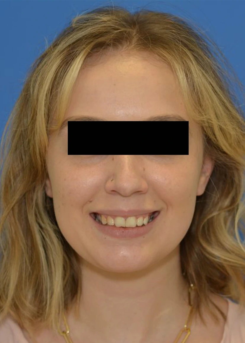 Botox - Patient 2 (front view after)