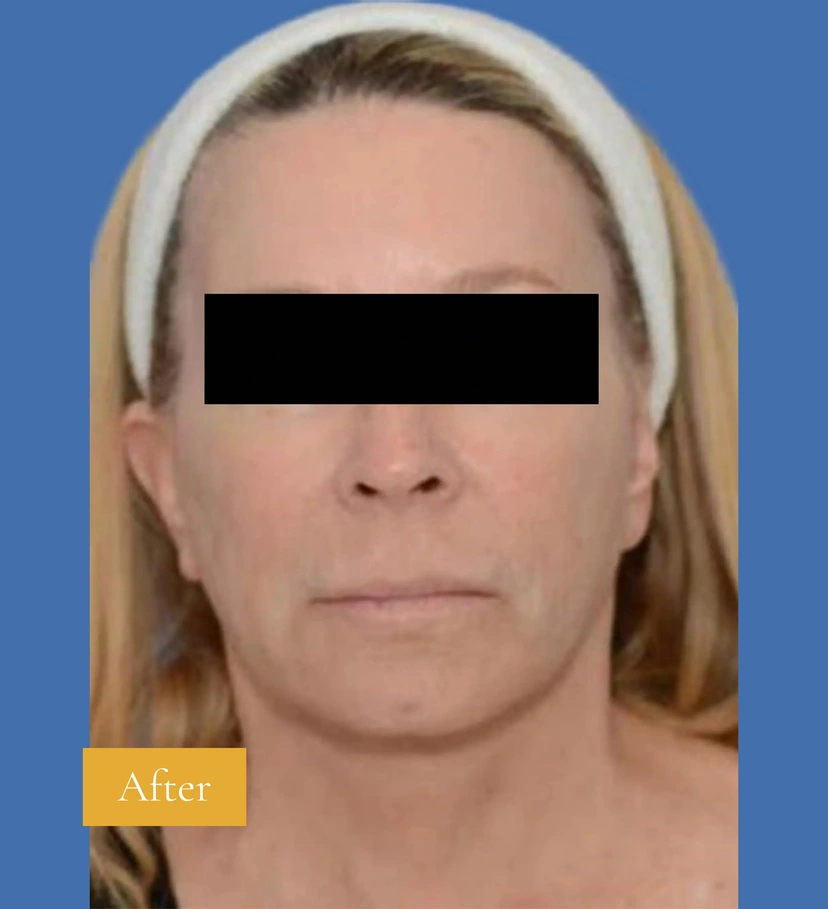 Liquid Facelift - Patient 1 (after)