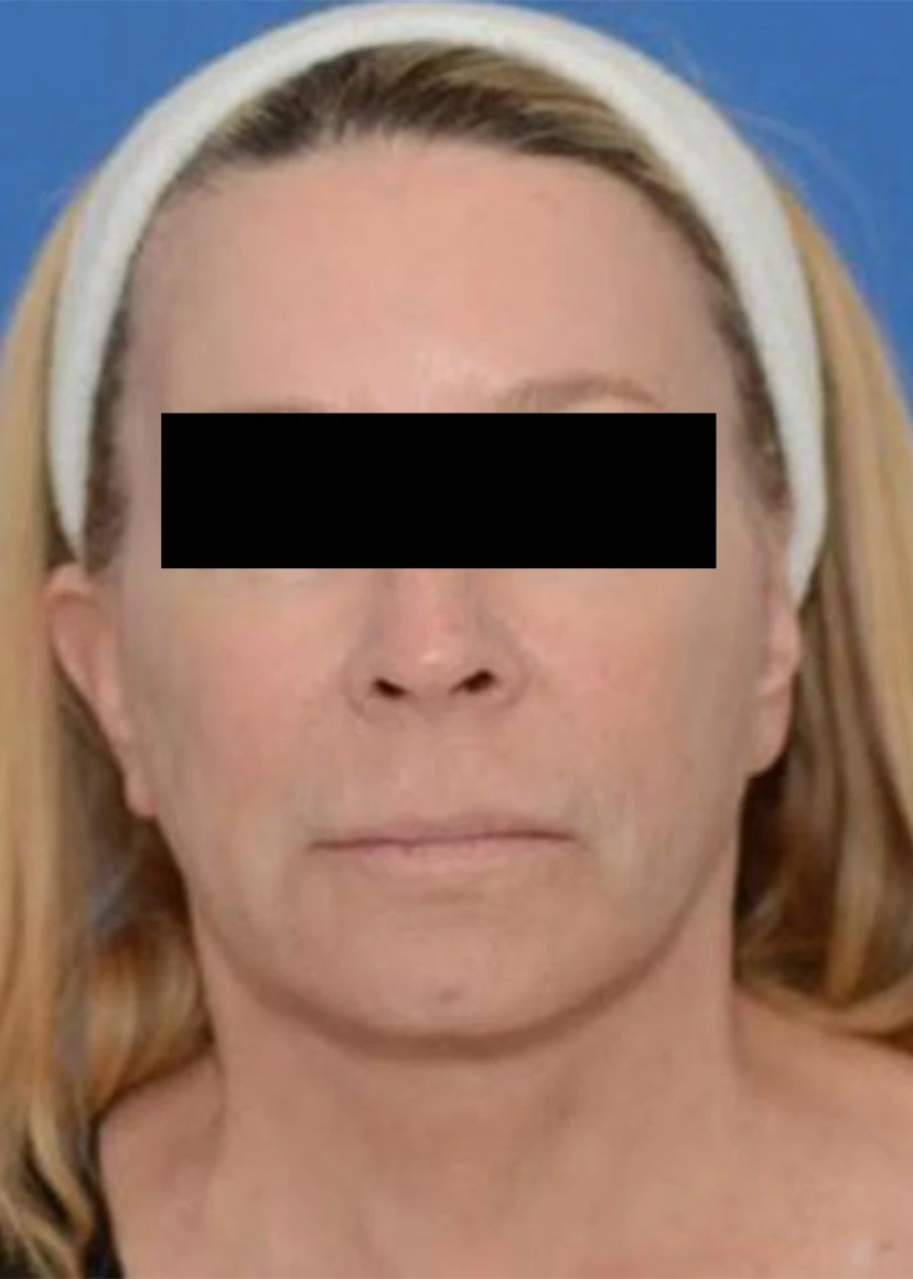Liquid Facelift - Patient 1 (after)