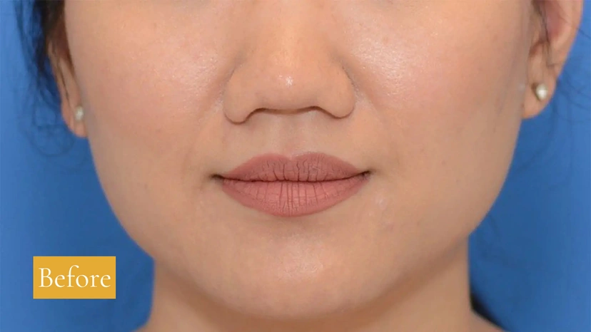 Botox - Patient 6 (front view before)